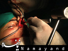 خارج کردن دندان از حفره بینی+تصاویر  عمل بینی