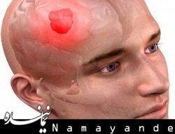 5 غذای سردردآور سردرد