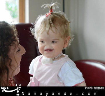 کودکی که بینی ندارد +عکس   کودک