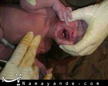 زن ۶۱ ساله تهرانی بچه دار شد! نوزاد عجیب