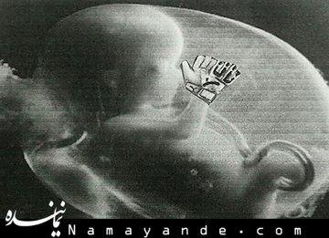 جنین ۵۰ ساله در بدن یک پیرزن!! جنین