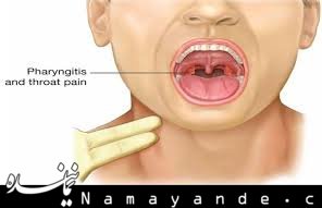 درمان نامناسب عفونت ساده گلو یکی از علل ابتلا به آبسه پشت حلقی پشت حلقی