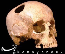 شواهدی از اولین جراحی مغز در دوران باستان 
 اولین جراحی معز