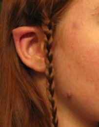 جراحی زیبایی، مدل گوش الاغی در تهران!+عکس مدل گوش الاغی