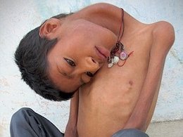 پسری که گردنش ۱۸۰ درجه خم میشود!+تصاویر بیماری نادر