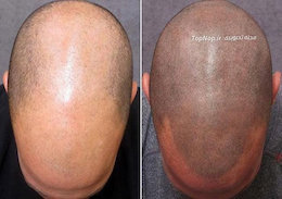 راه حل جدید درمان طاسی در مردان  درمان طاسی