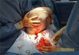 توده ۱۱ کیلویی از شکم یک زن در اراک خارج شد  توده