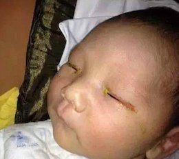 با تیک عصبی کودک چگونه برخورد کنیم؟ نابینایی نوزاد