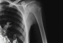 مردی که در ریه اش درخت رشد کرد!/عکس رشد درخت به ریه