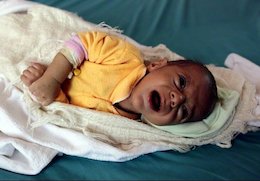 آمار تکان دهنده "یونیسف" از سوء تغذیه کودکان یمنی تصاویر دردناک از کودکان جنگ در یمن