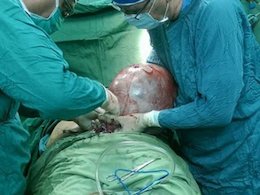 توده ۸کیلویی دربدن زن قمی +عکس  توده 8کیلویی دربدن