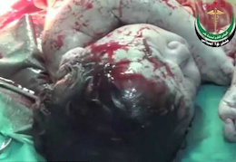 جراحی جنین و مادر ترکش خورده+تصاویر(۱۸+) جراحی نوزاد و مادر ترکش خورده