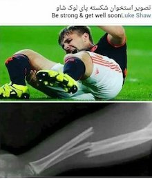 استخوان شکسته پای بازیکن منچستر یونایتد+عکس(۱۶+) لوک شاو