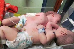 دو قلوهای بهم چسبیده اصفهانی جدا شدند+تصاویر دو قلوهای بهم چسبیده