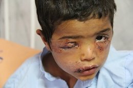 حمله سگ ولگرد به کودک ۳ساله +عکس  حمله سگ ولگرد به کودک