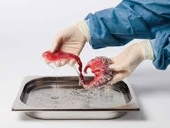 پیوند اندامهای حیوانات به انسان! پیوند اعضا 43