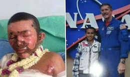 بلایی که سعودیها بر سر نوجوان نخبه یمنی آوردند/عکس عبدالله قیس السنبانی