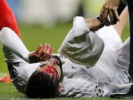 خون و خونریزی در بازی رئال و پاری سن ژرمن+تصاویر مصدومیت