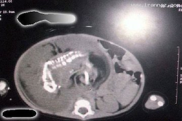 بارداری عجیب یک کودک ۱ ساله!/عکس بارداری عجیب یک کودک