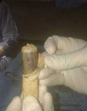 ۳ میلیون پولی که در شکم یک بیمار کشف شد!/عکس مخفی کردن پول در شکم