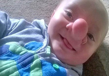 جراحی عجیب ترین بینی دنیا!/عکس بینی عجیب