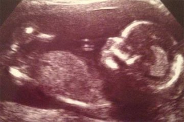 زنی که یک اُردک باردار است!!/عکس  جنین